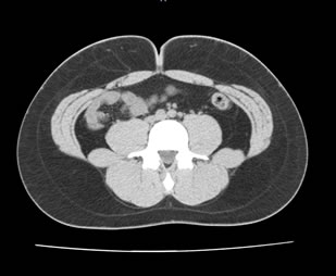 CT腹部画像